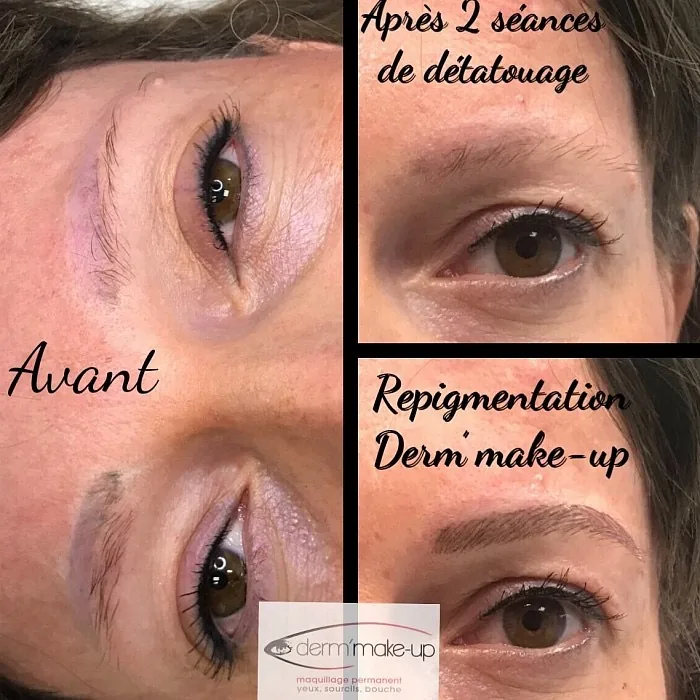 Détatouage et correction